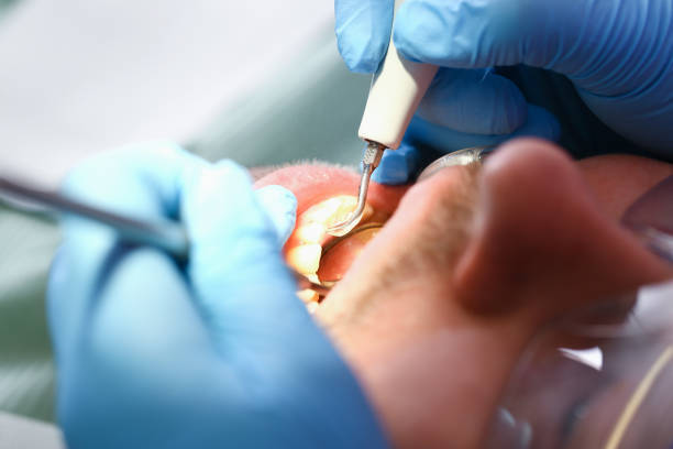 Best Emergency Dental Care for Broken or Chipped Teeth in Colma, CA